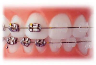 Esthetic Ceramic Braces